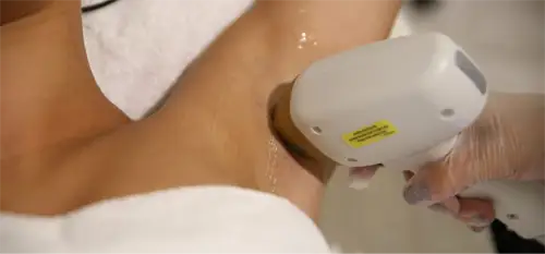 Laser Hair Removal At Aria Laser Hair Removal At Aria