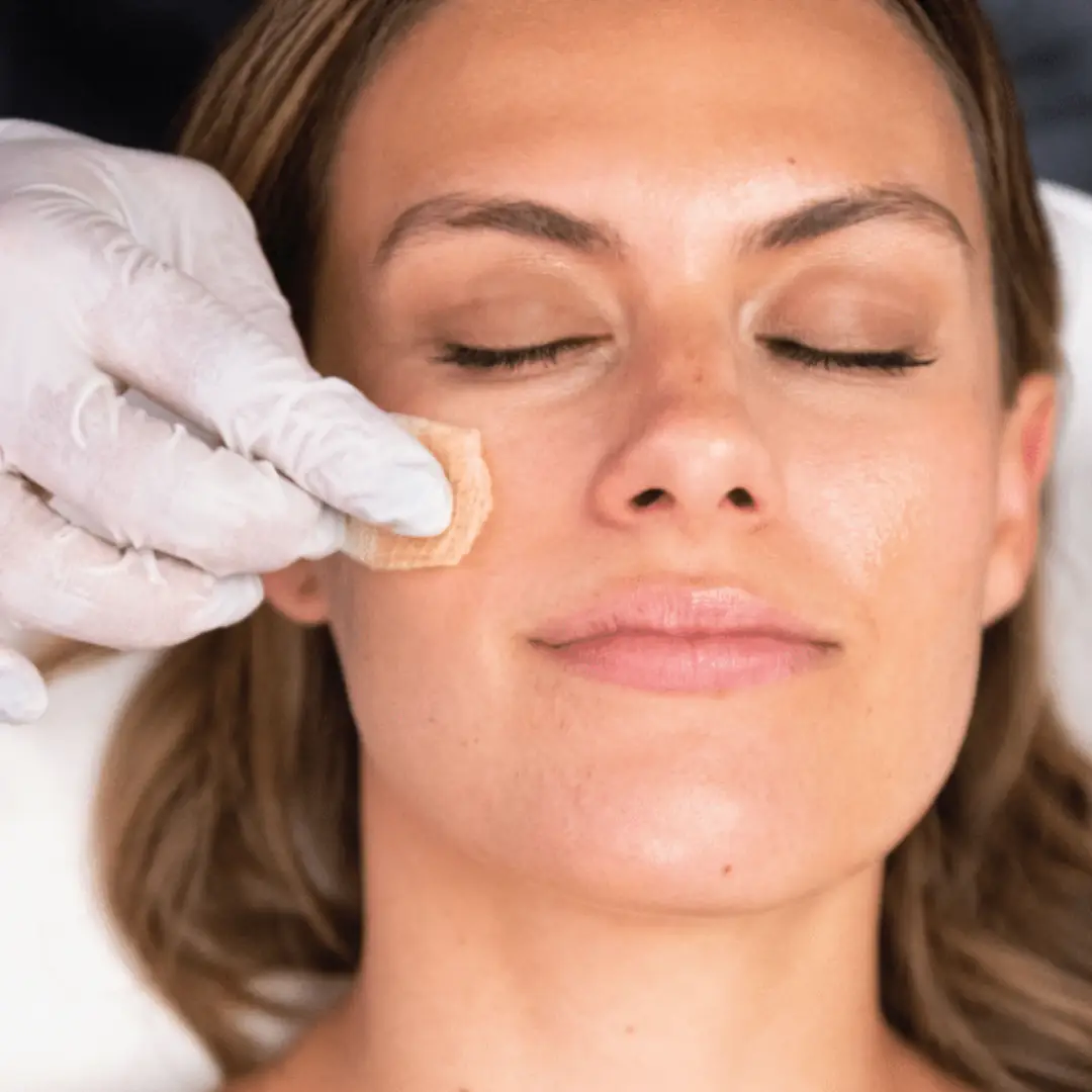 ChemPeelNew Chemical Peel Service from Aria Medical Aesthetics- image