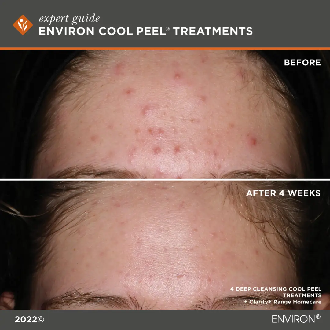 CoolPeelBnA2 Cool Peel Before and After image 1