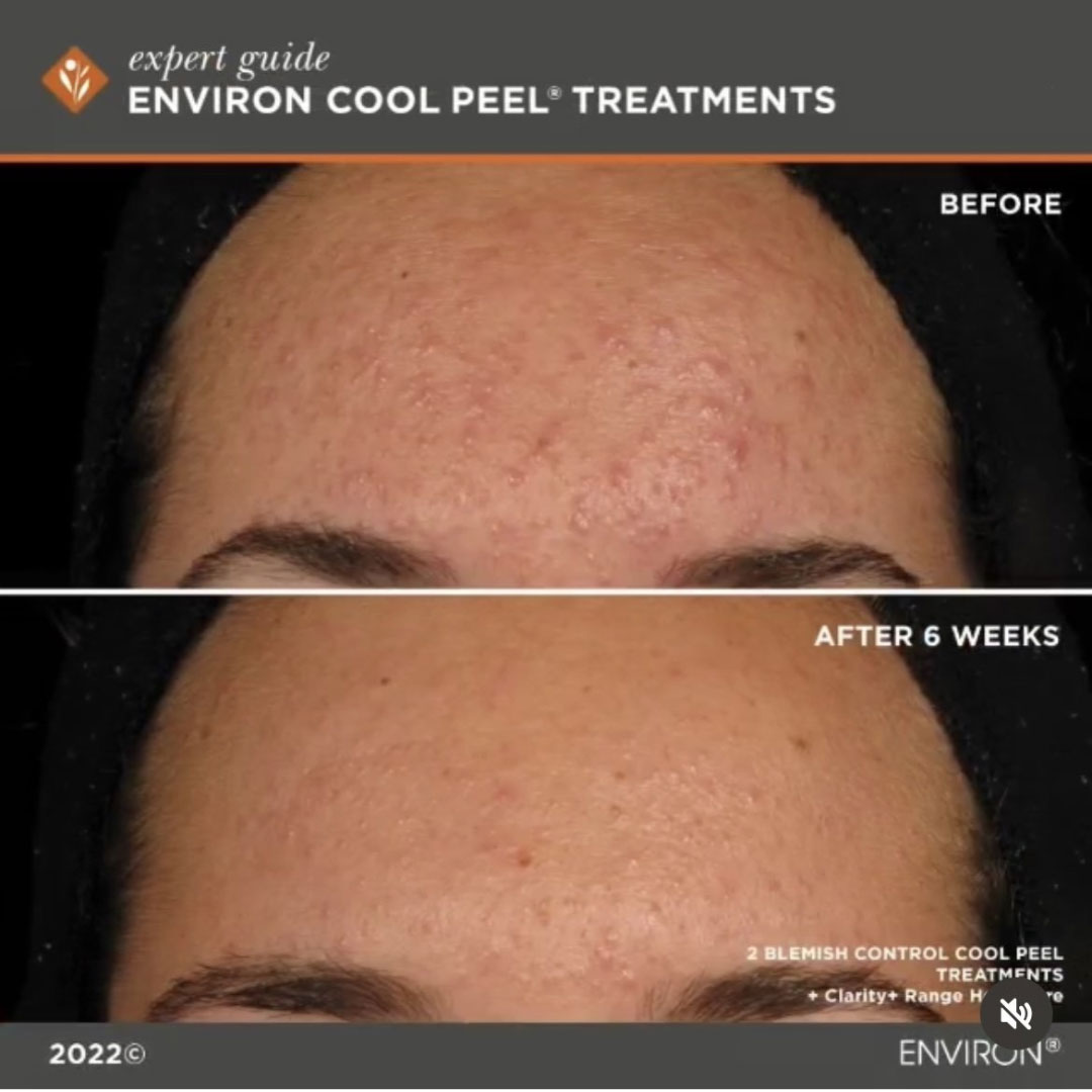 CoolPeelBnA3 Cool Peel Before and After image 2