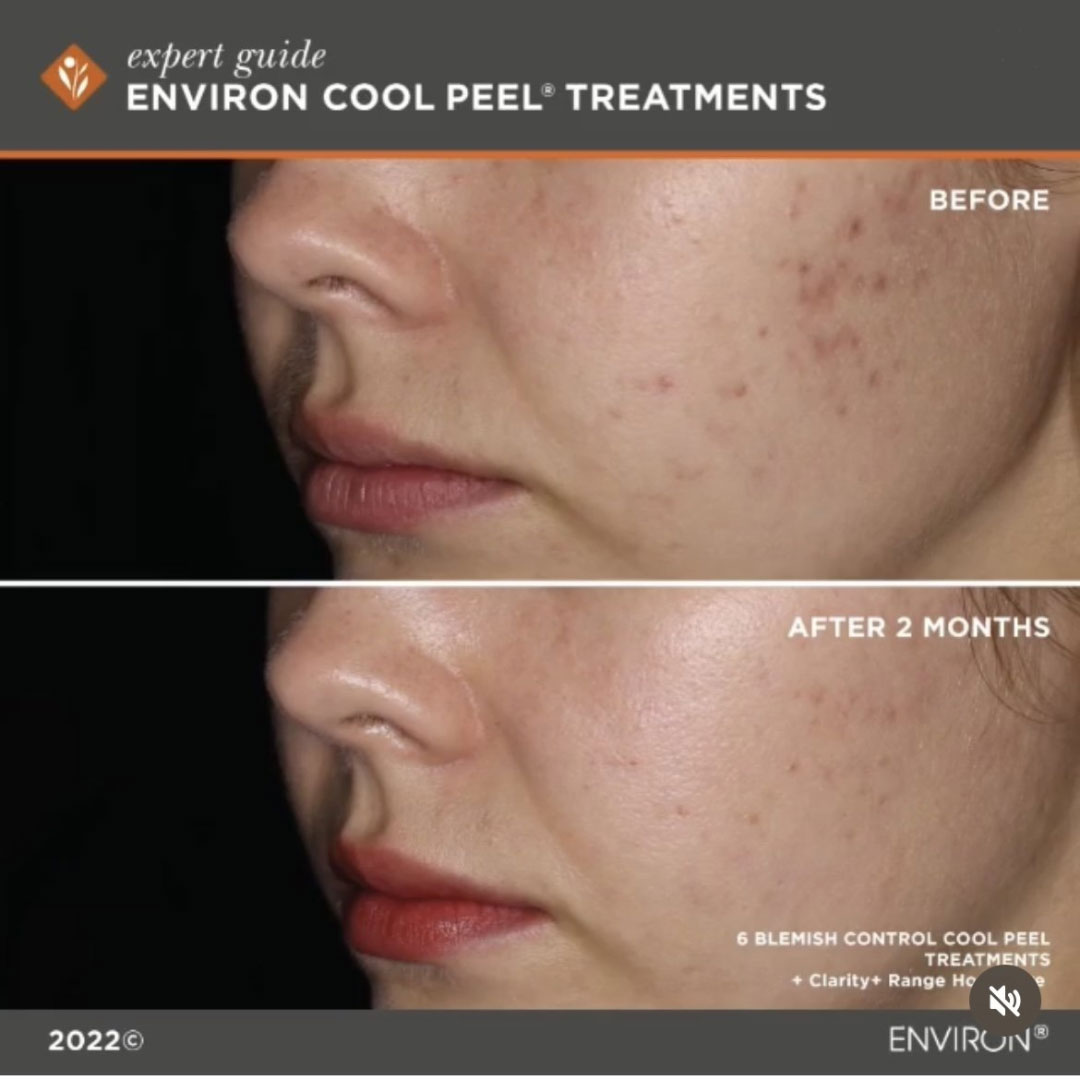 CoolPeelBnA4 Cool Peel Before and After image 3