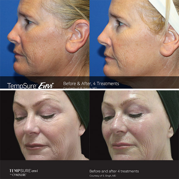 before-and-after-tempsure Aria shows the results of Tempsure treatments