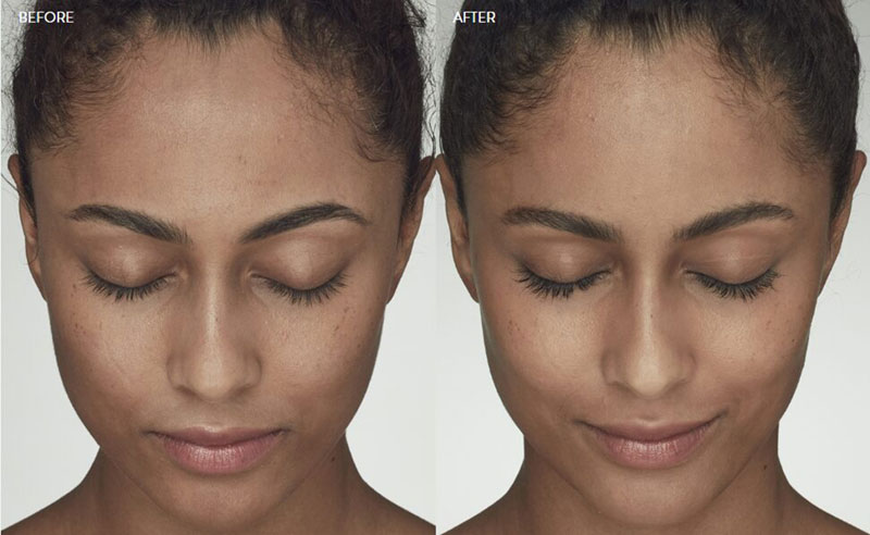Latisse-BA-Eyes-Closed Aria Latisse before and after image