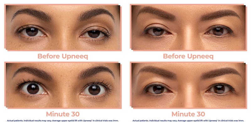 before-and-after Aria Upneeq before and after image