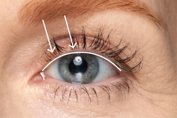 low-lying_lids-1 aria image how upneeq lifts your eyelid